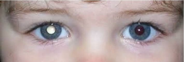 Retinoblastoma: Entenda o câncer da filha de Tiago Leifert